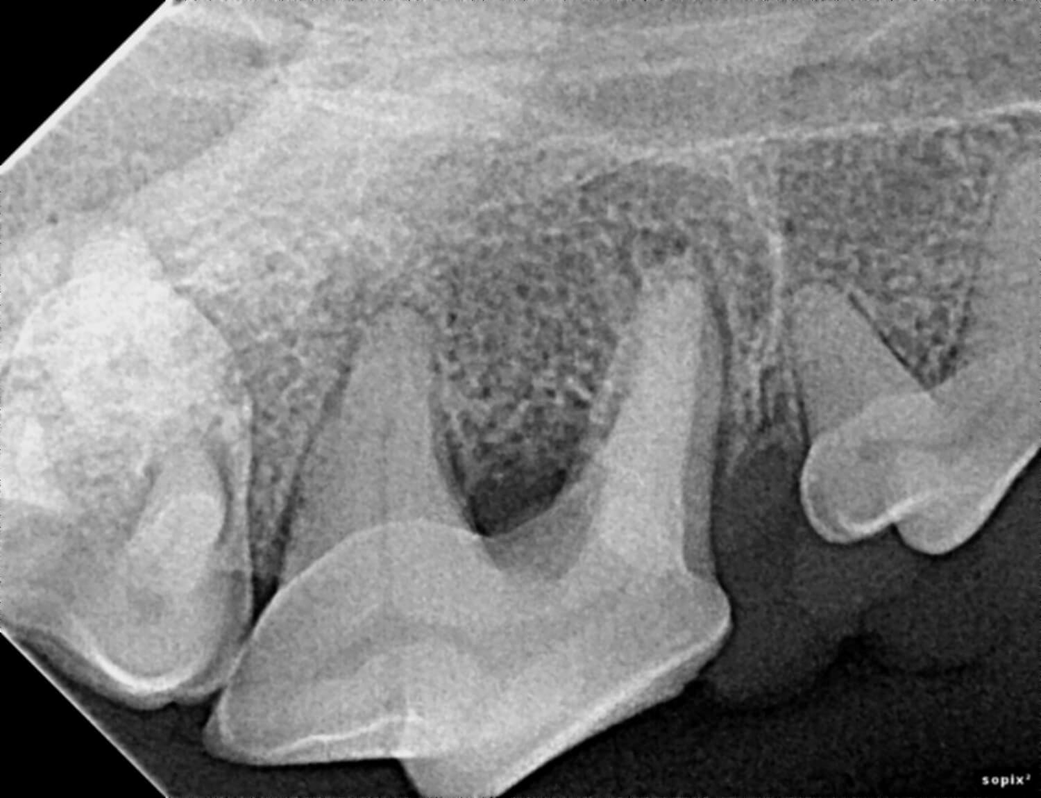 Dental X-Ray